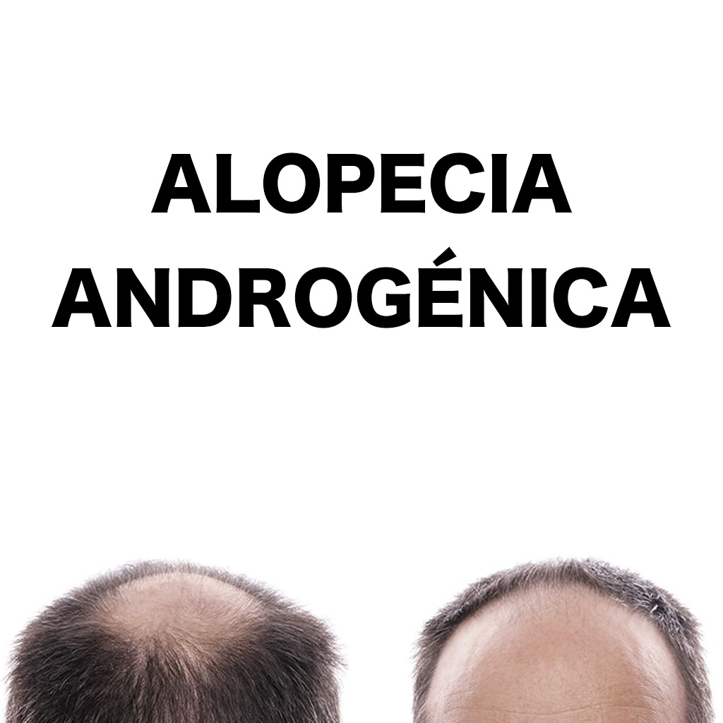 alopecia_androgenica alopecia androgénica