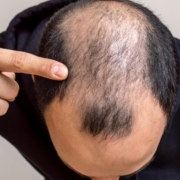 Efluvio Telógeno: Guía COMPLETA 2025 para Detener la Caída Repentina del Cabello y Recuperarlo 🥇 6 Efluvio Telógeno