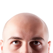 Alopecia Cicatricial: Guía 2025 DEFINITIVA para Entender Tipos, Causas y Tratamientos 4 Imagen de alopecia cicatricial mostrando la superficie del cuero cabelludo con zonas de calvicie donde la piel se ve lisa y brillante debido a la cicatrización de los folículos pilosos. Ejemplo visual de los cambios en la piel asociados a la alopecia cicatricial.