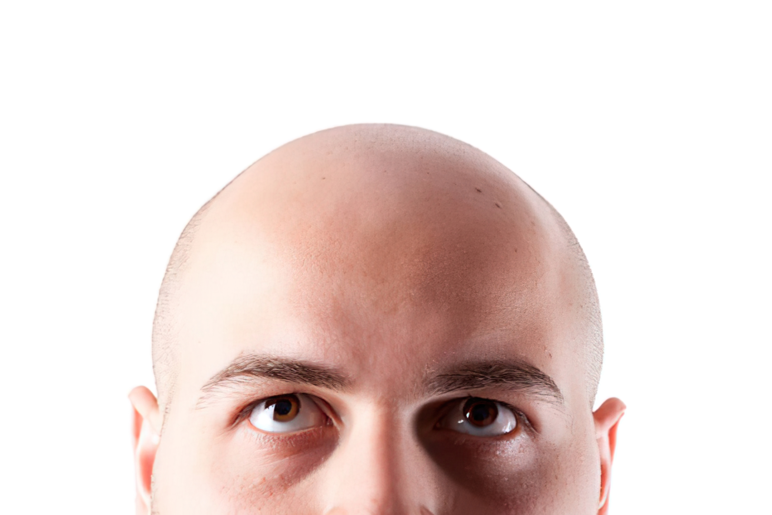 Imagen de alopecia cicatricial mostrando la superficie del cuero cabelludo con zonas de calvicie donde la piel se ve lisa y brillante debido a la cicatrización de los folículos pilosos. Ejemplo visual de los cambios en la piel asociados a la alopecia cicatricial.