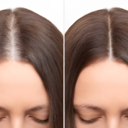 Diccionario Definitivo de la Caída del Cabello 2025: Glosario de Términos, Causas y Tratamientos 2 before-after-head-shot-young-600nw-2462375535alt